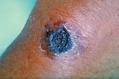 Diseases with Horse-to-Human Transmission, Can you get a disease from your horse? Ringworm horses, equine Rabies, Anthrax horses, diseases horses housed livestock, horses poll-evil, diseases equine veterinarians can catch from horses